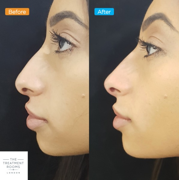 Non-surgical nose job
